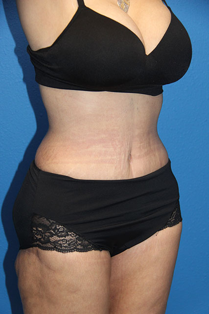 Case--7603 | After Tummy Tuck 2