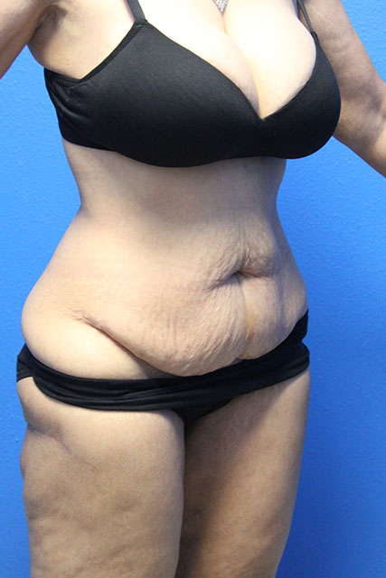 Case--7603 | Before Tummy Tuck 2