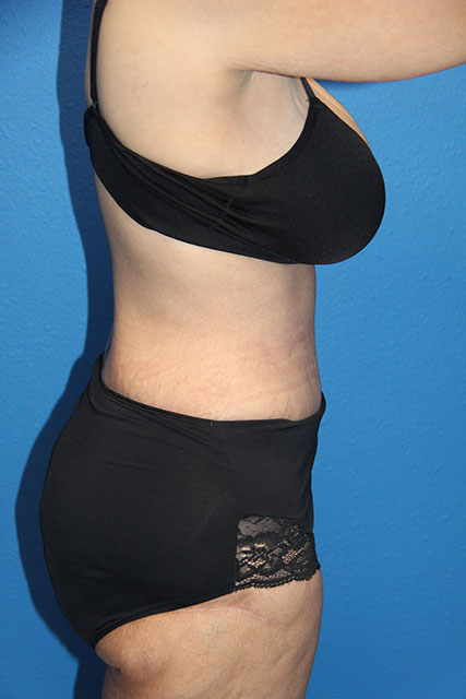Case--7603 | After Tummy Tuck 4