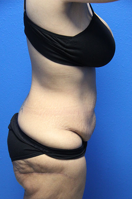 Case--7603 | Before Tummy Tuck 4