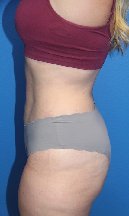 Case--6702 | After Liposuction 2