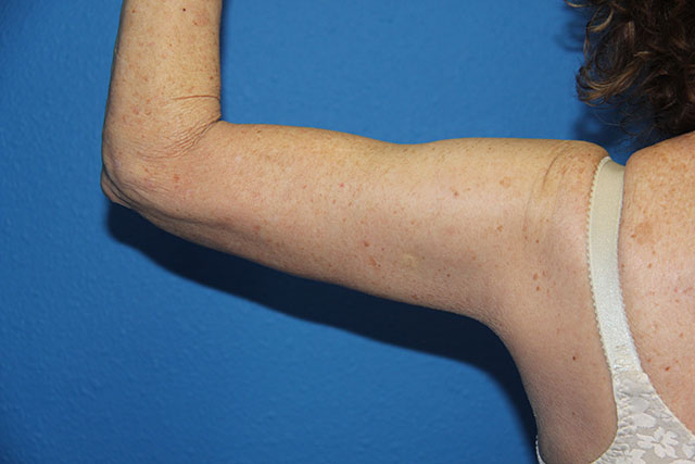 Case--8085 | After Arm Lift / Brachioplasty 1