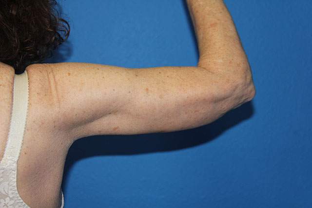 Case--8085 | After Arm Lift / Brachioplasty 2
