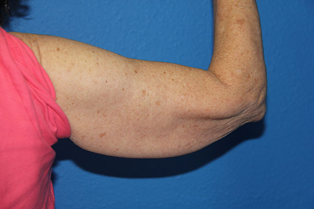 Case--8085 | Before Arm Lift / Brachioplasty 2