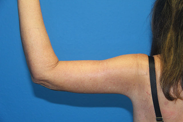 Case--4429 | After Arm Lift / Brachioplasty 1