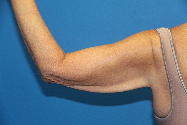 Case--4429 | Before Arm Lift / Brachioplasty 1
