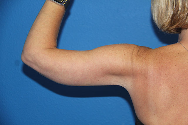 Case--1489 | After Arm Lift / Brachioplasty 1