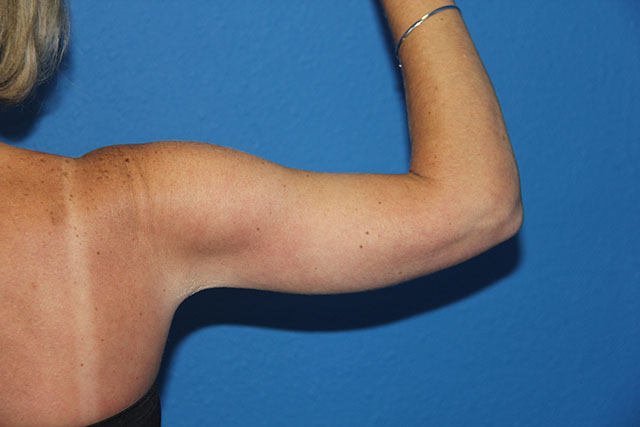 Case--1489 | After Arm Lift / Brachioplasty 2