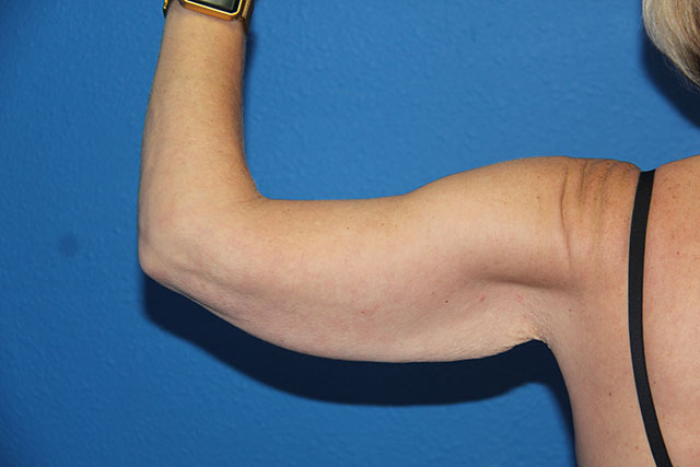 Case--1489 | Before Arm Lift / Brachioplasty 1