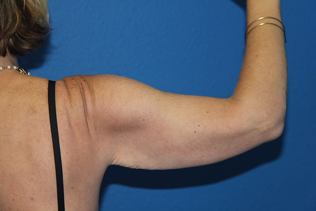 Case--1489 | Before Arm Lift / Brachioplasty 2
