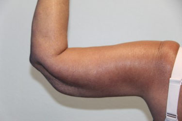 Case--6775 | After Arm Lift / Brachioplasty 1