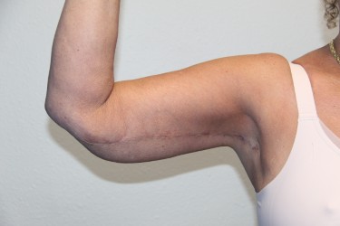 Case--6775 | After Arm Lift / Brachioplasty 2