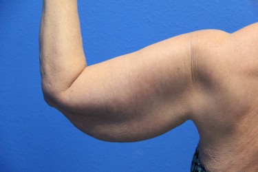 Case--6775 | Before Arm Lift / Brachioplasty 1
