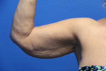 Case--6775 | Before Arm Lift / Brachioplasty 2