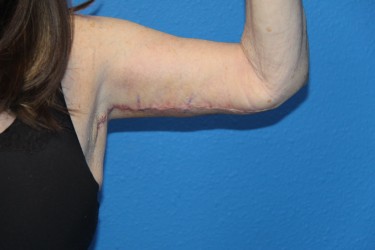 Case--6615 | After Arm Lift / Brachioplasty 2