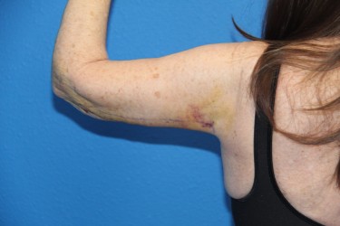 Case--6615 | After Arm Lift / Brachioplasty 1