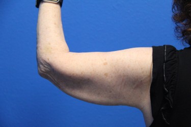 Case--6615 | Before Arm Lift / Brachioplasty 1