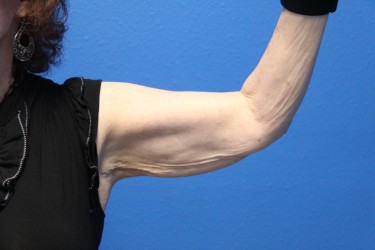 Case--6615 | Before Arm Lift / Brachioplasty 2