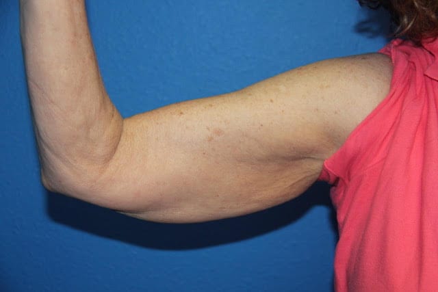 Case--3771 | Before Arm Lift / Brachioplasty 2
