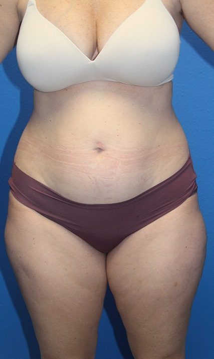 Case--6702 | Before Liposuction 1