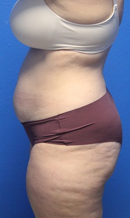 Case--6702 | Before Liposuction 2