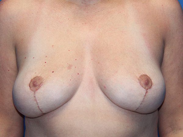 Case--1391 | After Breast Implant Removal and Breast Lift 1