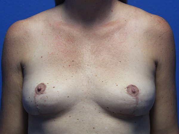 Case--8435 | After Breast Implant Removal and Breast Lift 1