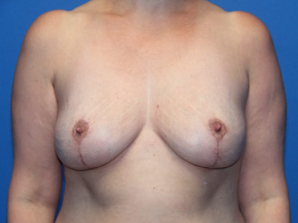Case--8744 | After Breast Implant Removal and Breast Lift 1