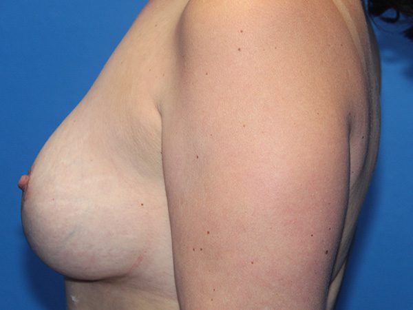 Case--8744 | After Breast Implant Removal and Breast Lift 2