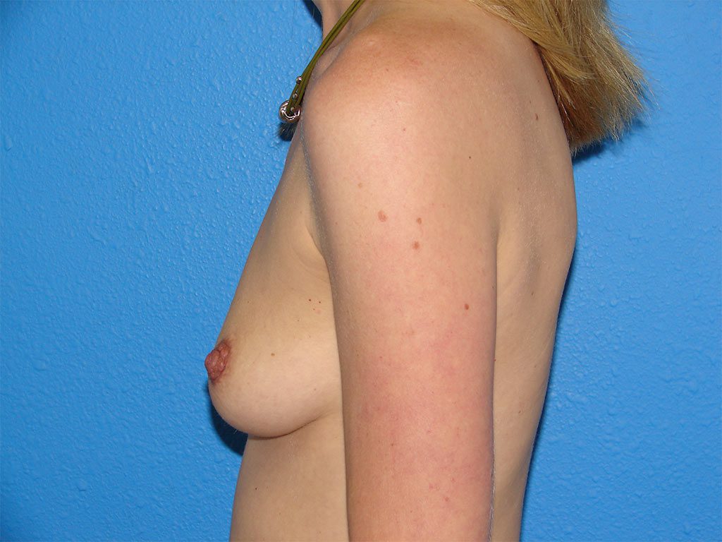Case--4672 | Before Breast Augmentation 4