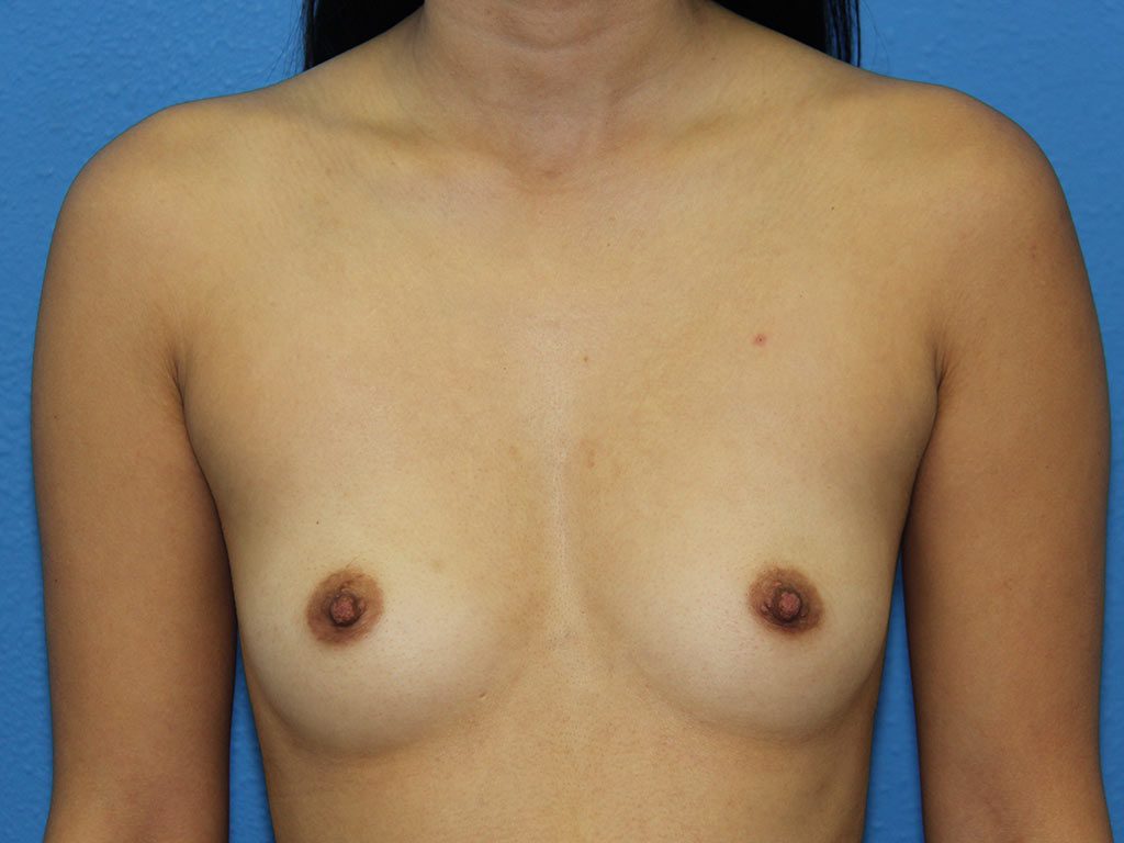 Case--5923 | Before Breast Augmentation 1
