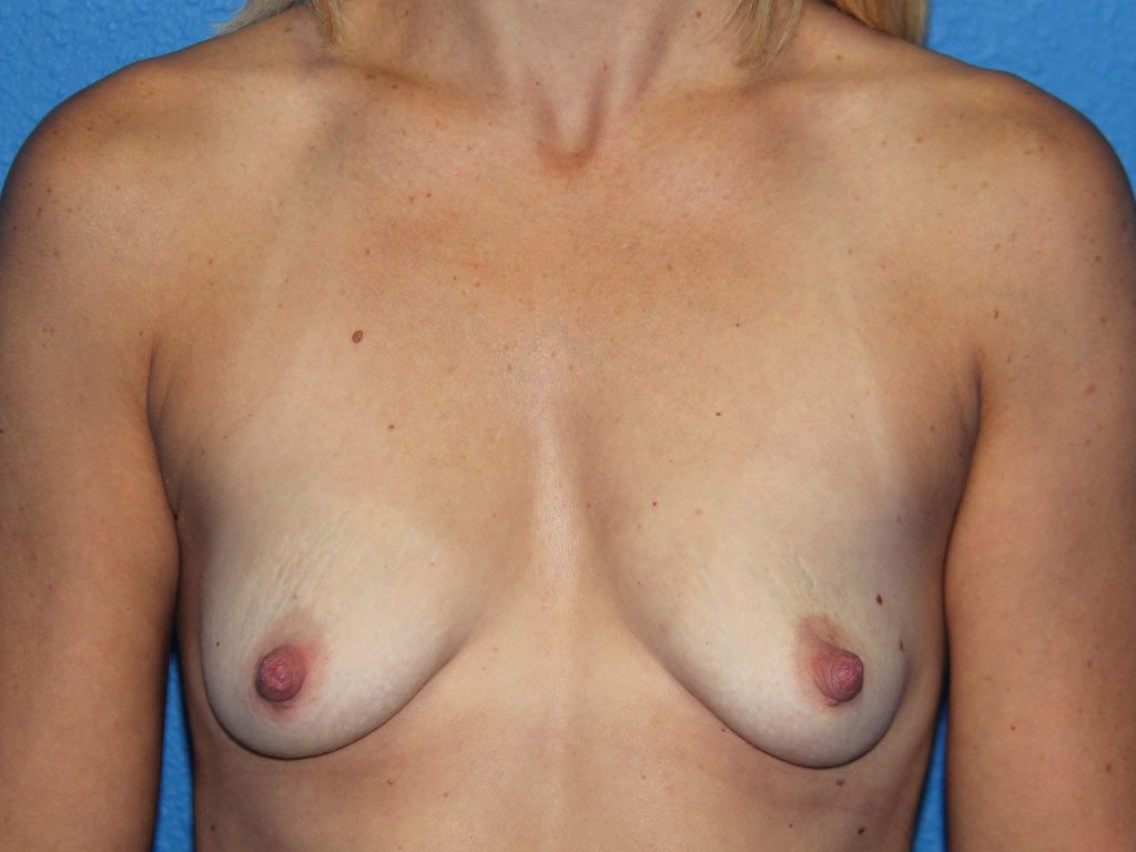 Case--5400 | Before Breast Augmentation 1