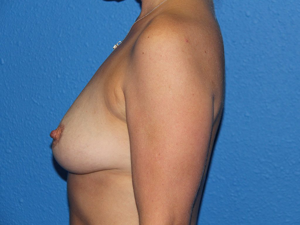 Case--8422 | Before Breast Augmentation 3