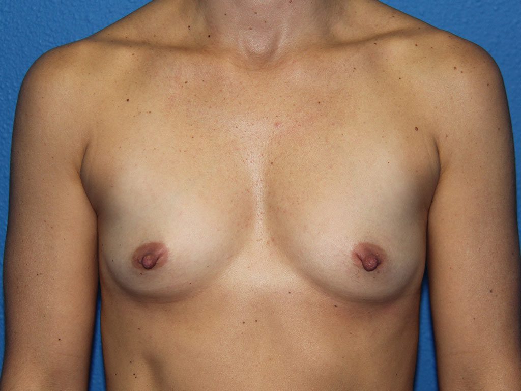 Case--6233 | Before Breast Augmentation 1