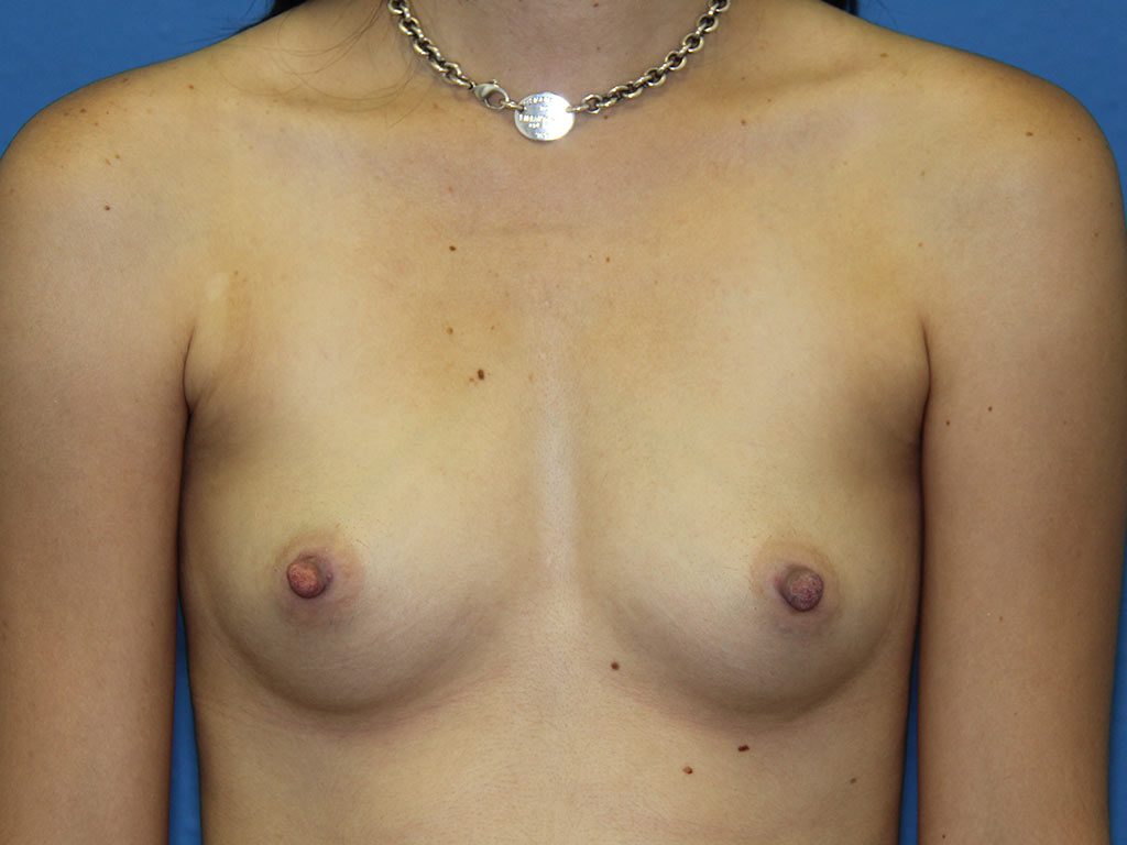 Case--9778 | Before Breast Augmentation 1