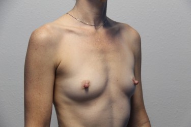 Case--2238 | Before Breast Augmentation 3