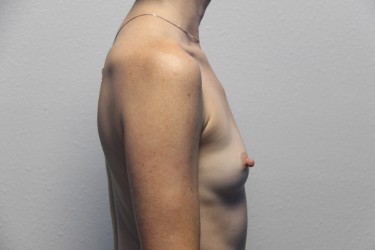 Case--2238 | Before Breast Augmentation 2