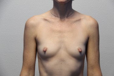 Case--2238 | Before Breast Augmentation 1
