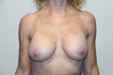 Case--1216 | After Breast Augmentation 1