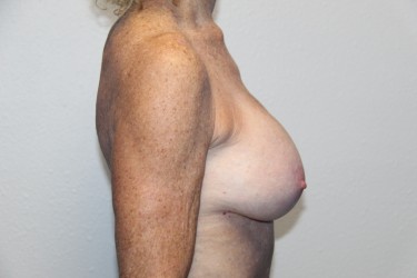 Case--1216 | After Breast Augmentation 2