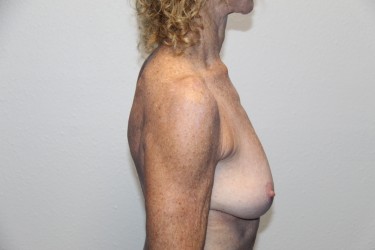 Case--1216 | Before Breast Augmentation 2