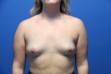 Case--6485 | Before Breast Augmentation 1