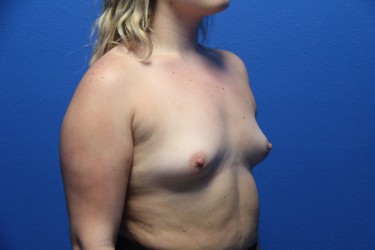 Case--6485 | Before Breast Augmentation 2