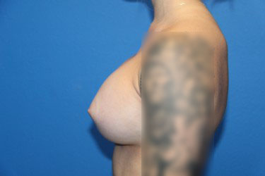 Case--4391 | After Breast Augmentation 2