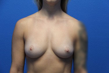 Case--4391 | Before Breast Augmentation 1