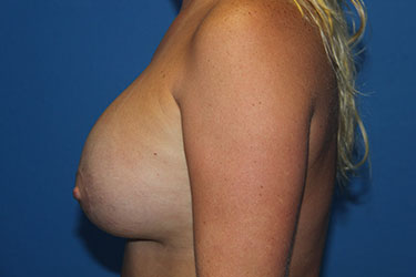 Case--9998 | After Breast Augmentation 3