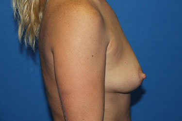 Case--9998 | Before Breast Augmentation 2
