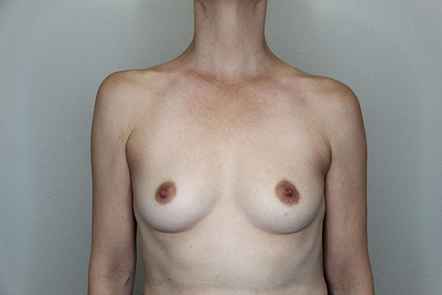 Case--5686 | Before Breast Augmentation 1