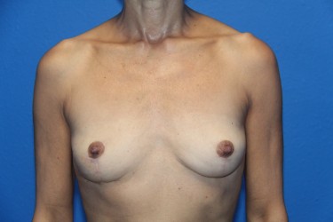 Case--8242 | After Breast Implant Removal 1