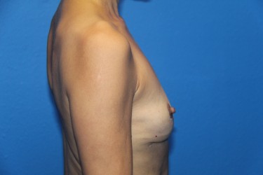 Case--8242 | After Breast Implant Removal 2